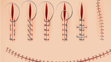 متى تطيح خيوط العملية التجميلية للمهبل