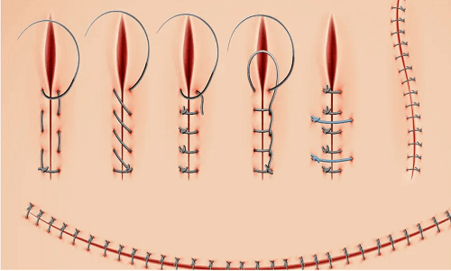 متى تطيح خيوط العملية التجميلية للمهبل