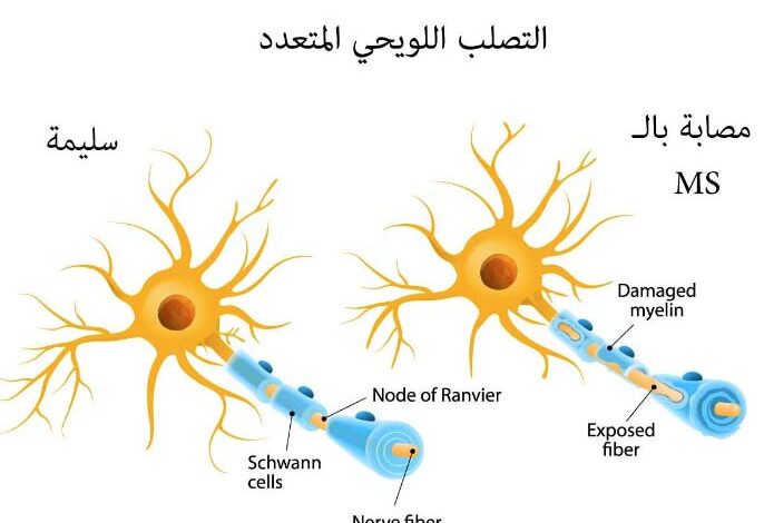 أعراض التصلب اللويحي عند النساء