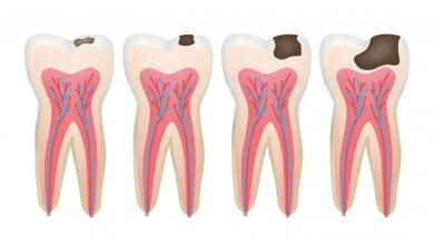 علاج تسوس الاسنان